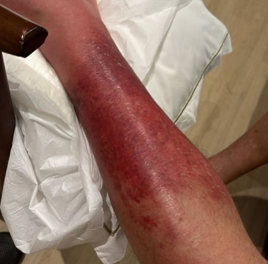 Melhora no Estado de Sa�de de Jair Bolsonaro: Ex-Presidente Combate Erisipela com Sucesso