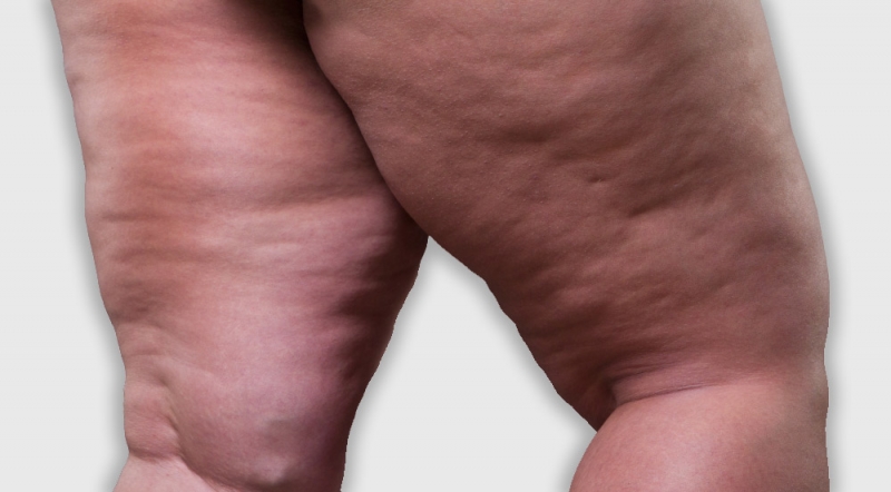 Lipedema: A Doen�a Silenciosa que Afeta Milhares de Mulheres