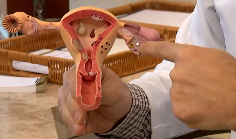 Endometriose: identificando sintomas e opes de tratamento
