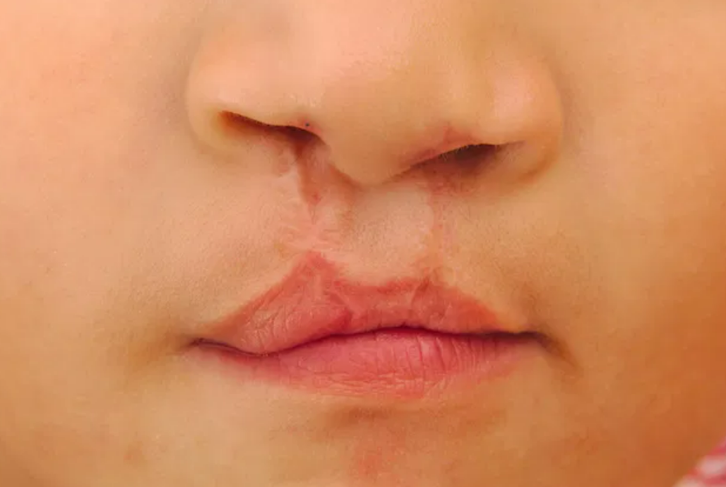 Lula sanciona lei que obriga SUS a ofertar cirurgia de l�bio leporino